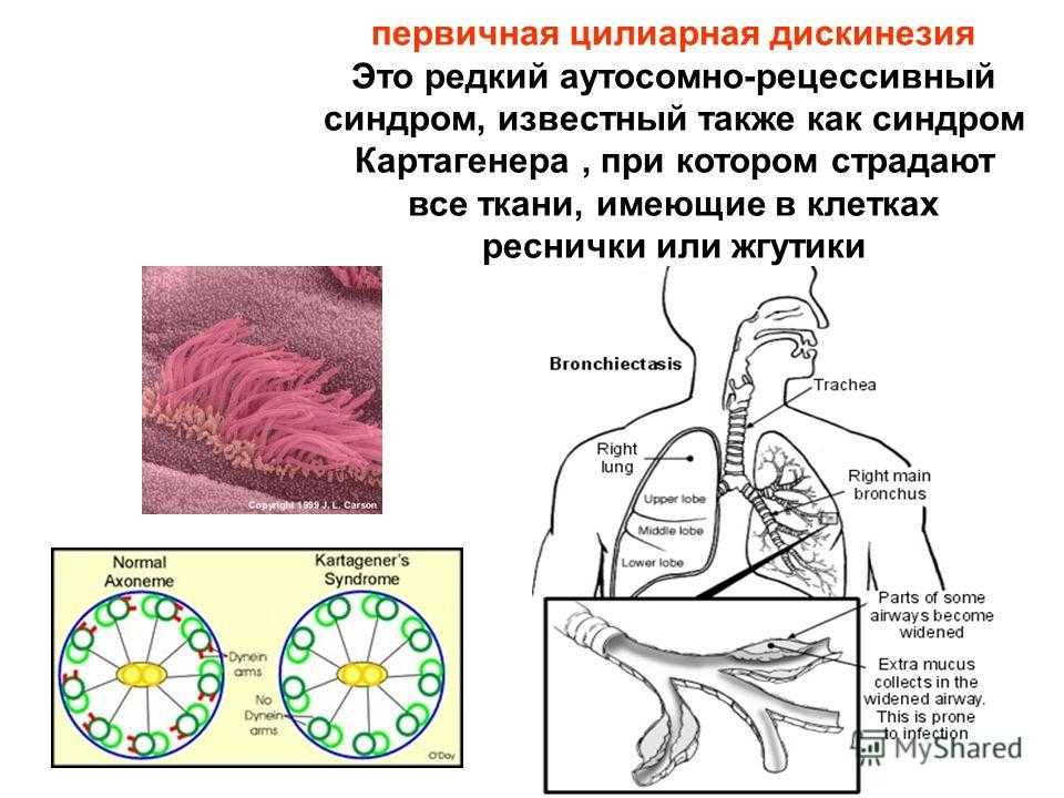 Наследственные болезни