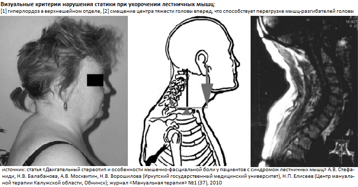 Мр картина нарушения статики шейного отдела позвоночника