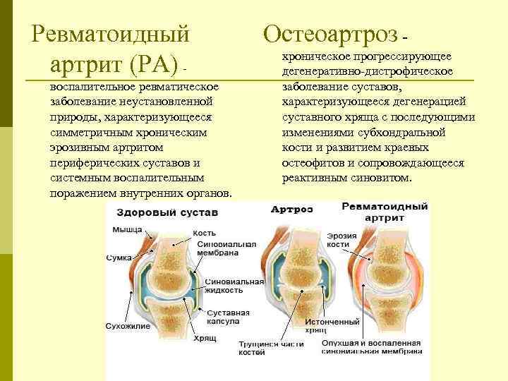 Диагноз доа суставов. Ревматоидный артрит и остеоартроз разница. Ревматоидный артрит и остеоартрит. Ревматоидный артрит симметричное поражение суставов. Ревматоидный артрит остеоартрит таблица.