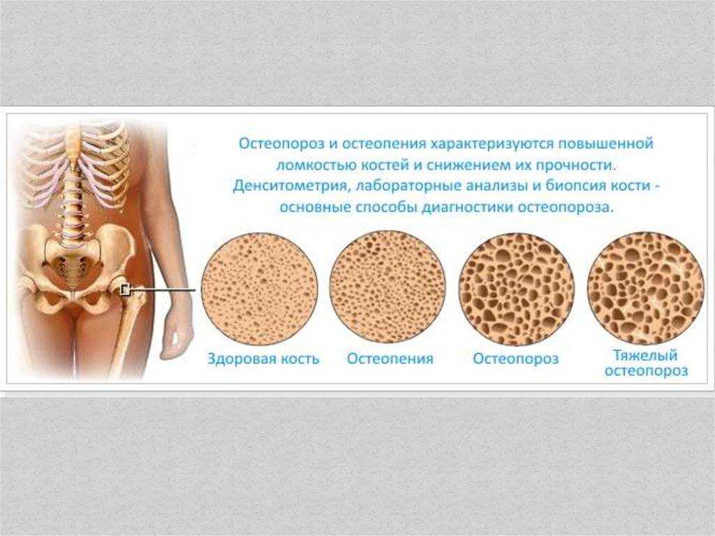 Причина костного заболевания. Остеопороз. Остеопения и остеопороз. Болезнь костей остеопороз. Повышенная ломкость костей.