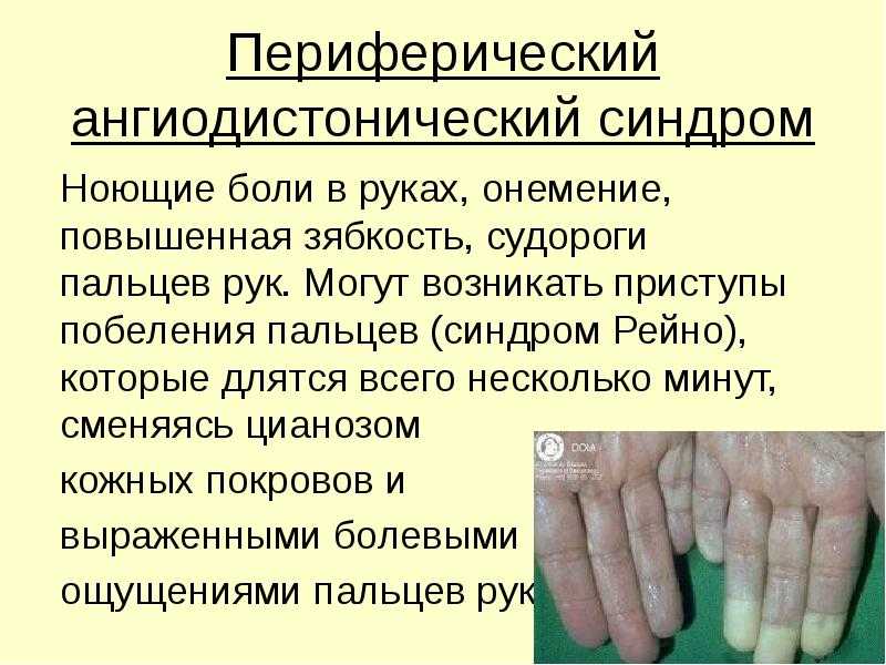 Синдром рейно