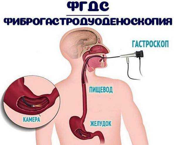 Де нол при бульбите схема