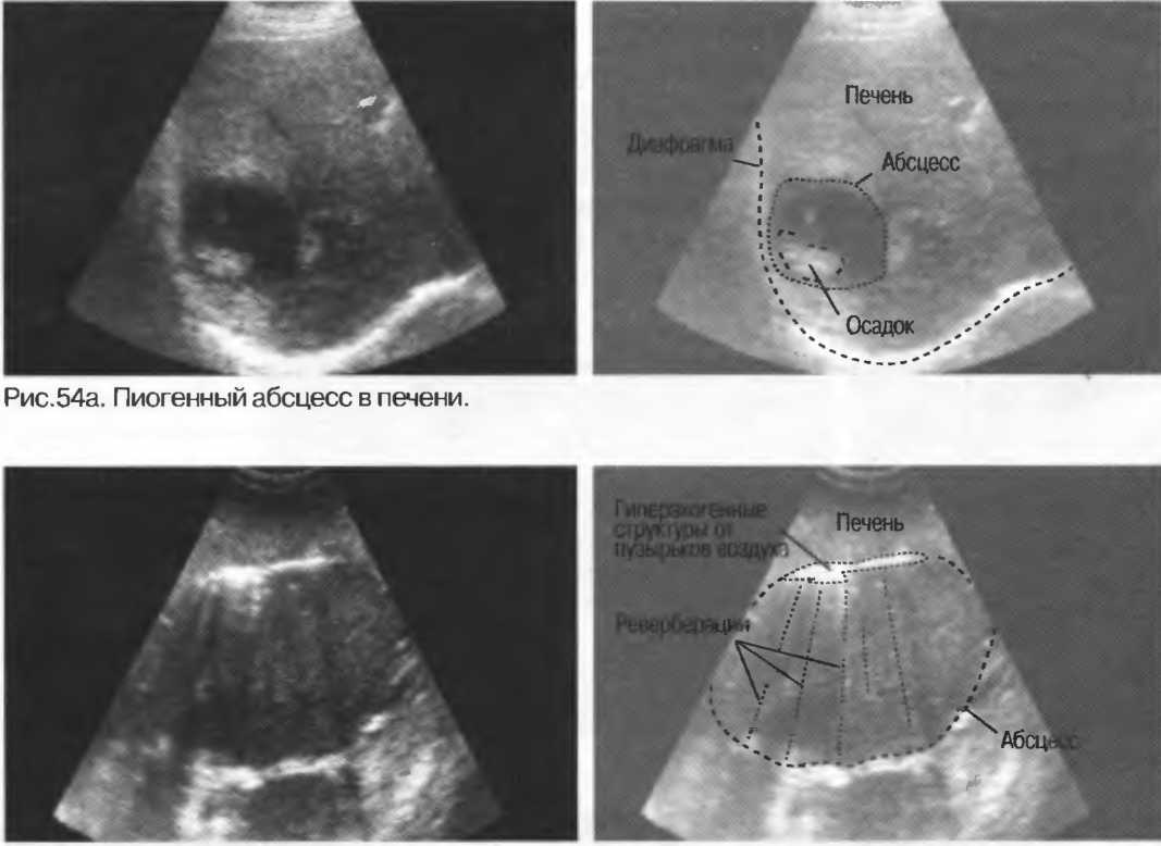Абсцесс печени узи картина