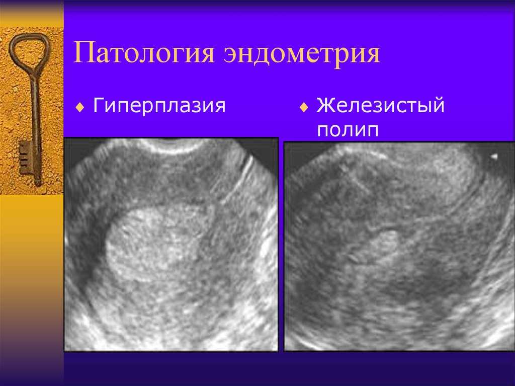 Гиперплазия эндометрия матки презентация