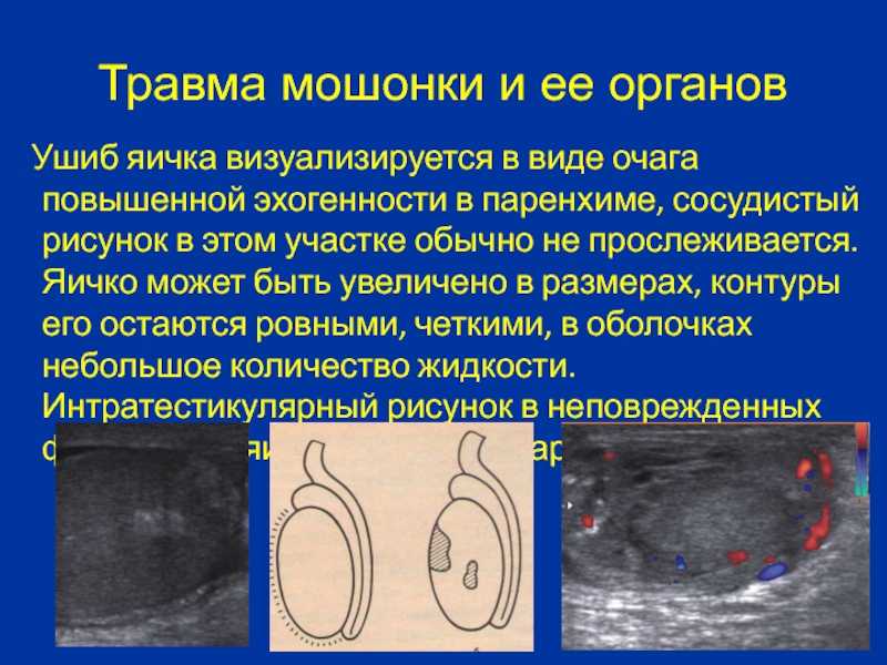 Острые заболевания органов мошонки (синдром острой мошонки)