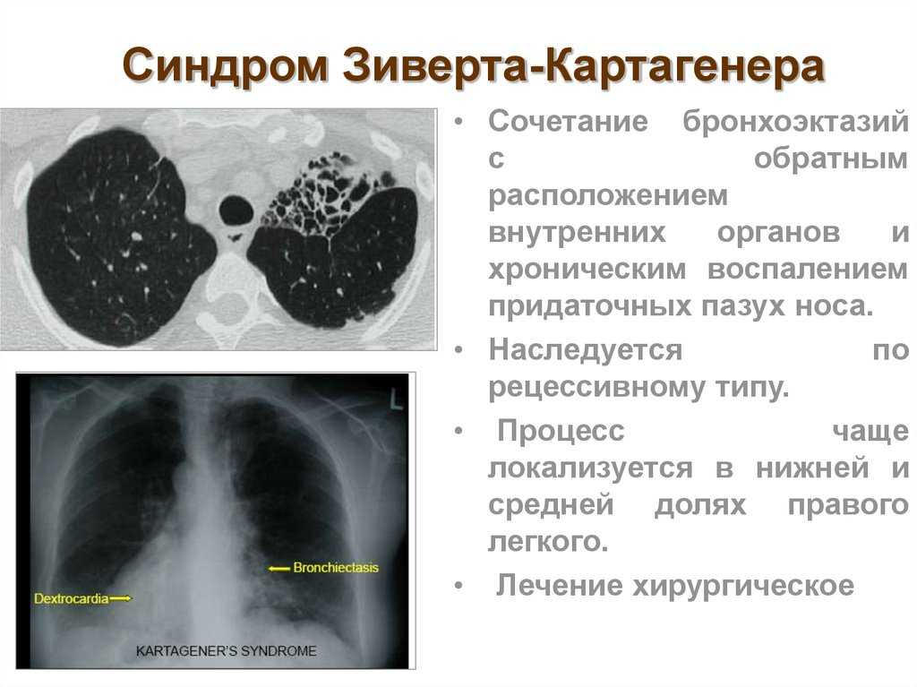 Цилиопатии