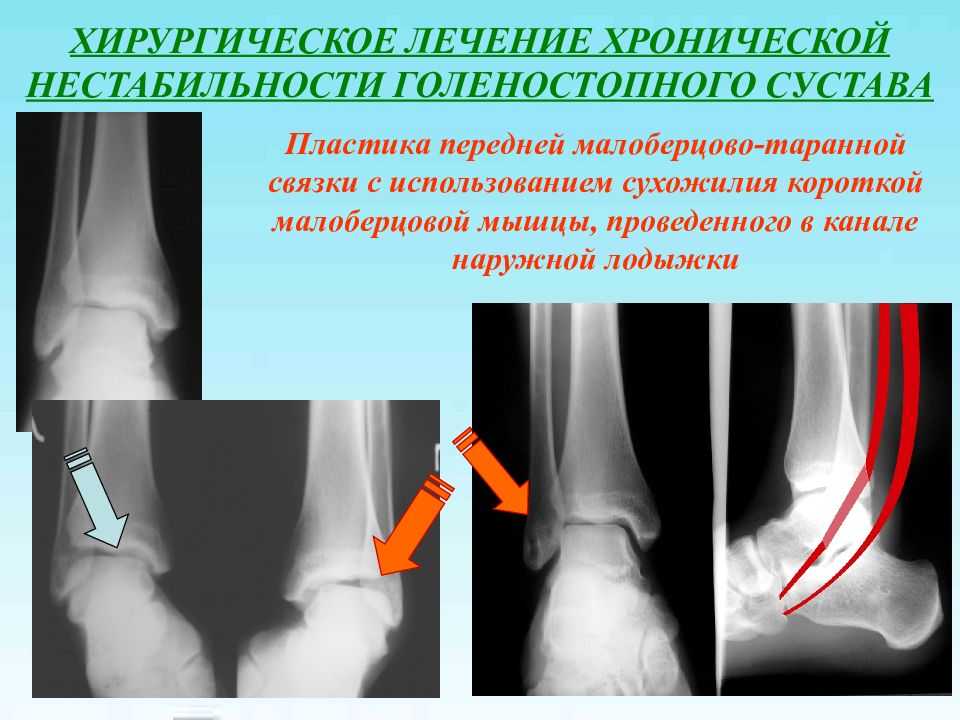 Лечение голеностопа. Нестабильность голеностопного сустава. Хроническая нестабильность голеностопного сустава. Латеральная нестабильность голеностопного сустава. Деторзия голеностопного сустава.