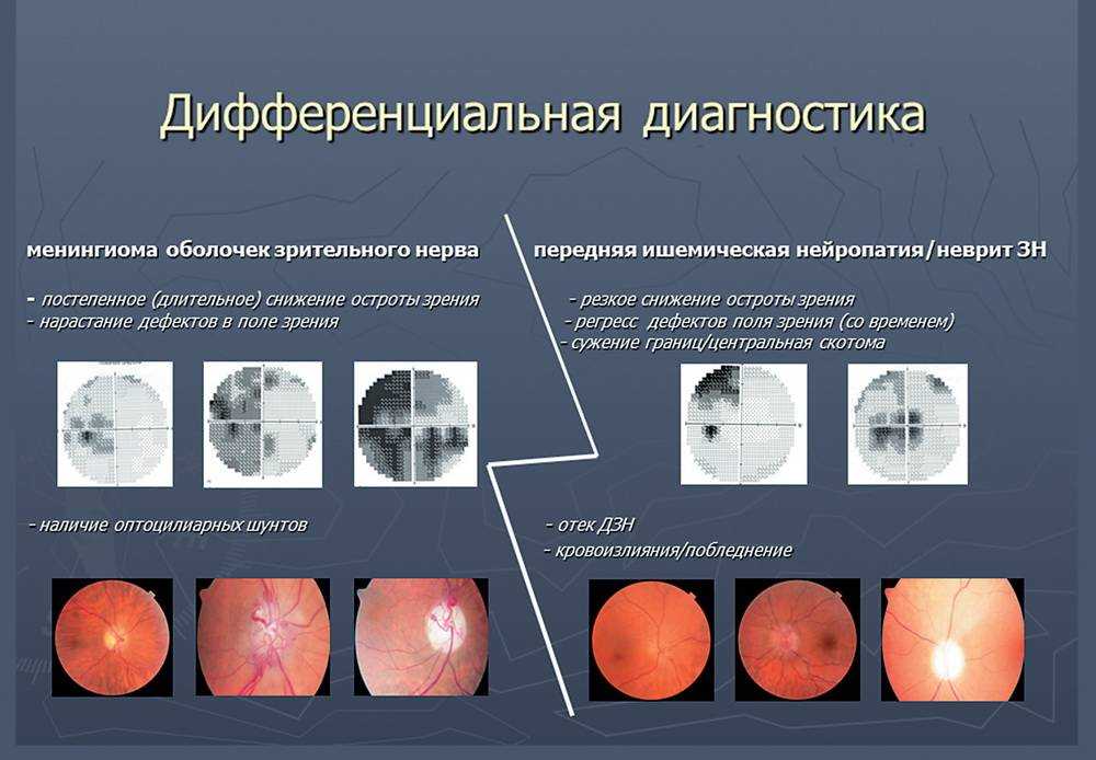 Частичная атрофия зрительного нерва: лечение, симптомы у детей - medside.ru