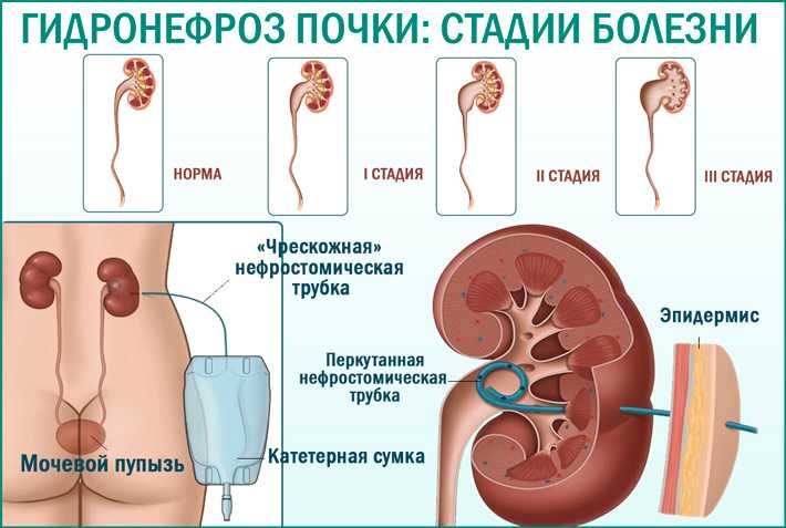 «поздний» гидронефроз. современные подходы к диагностике и лечению