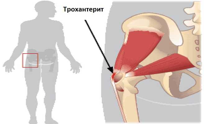 Перитрохантерит тазобедренного сустава. Трохантерит тазобедренного сустава. Вертельный бурсит тазобедренного. Трохантерит сухожилия бедра. Трохантерита тазобедренного сустава симптомы.