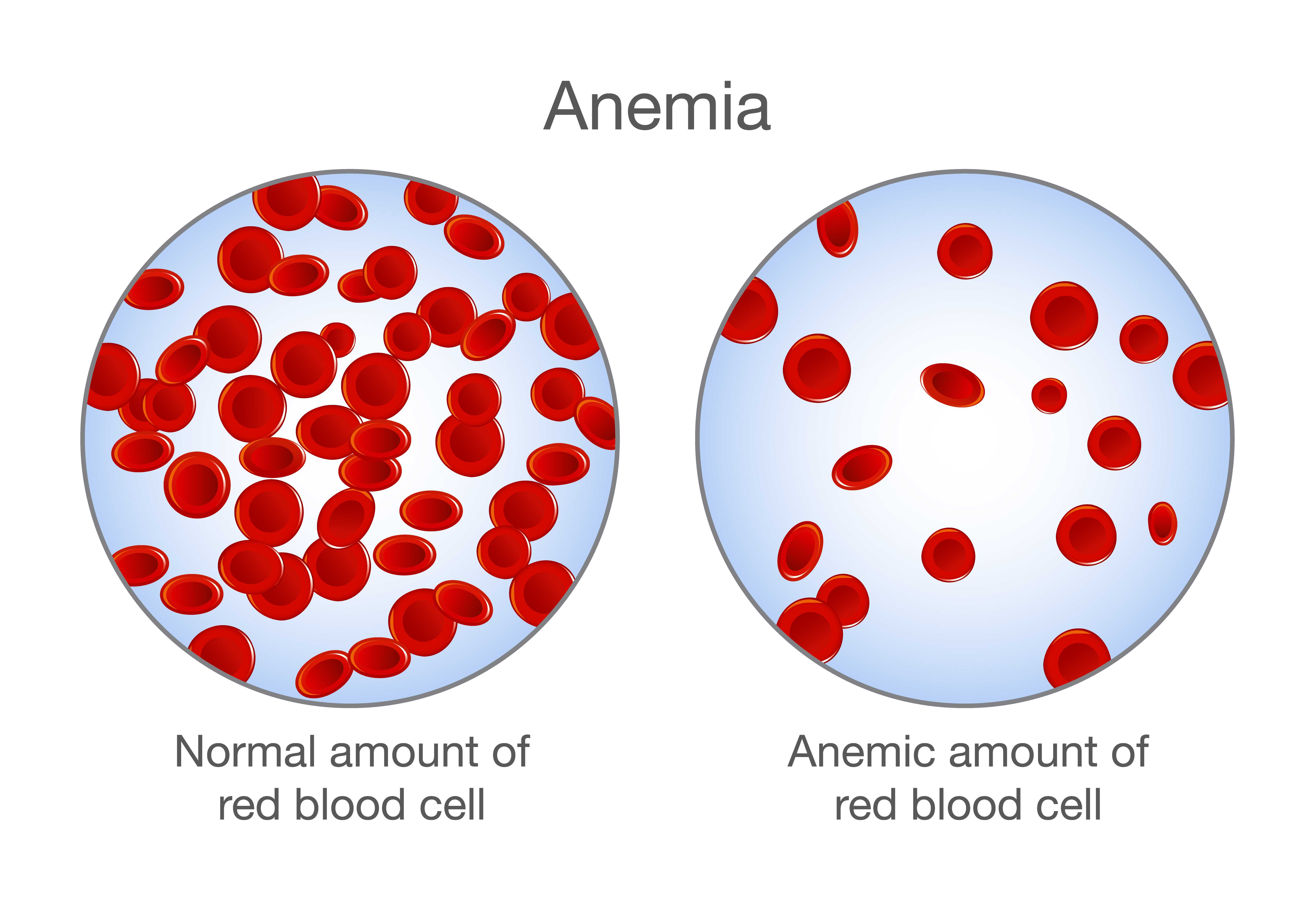Анемия в моче. Жда эритроциты. Эритроциты в крови анемия. Эритроциты при анемии. Анемия рисунок.