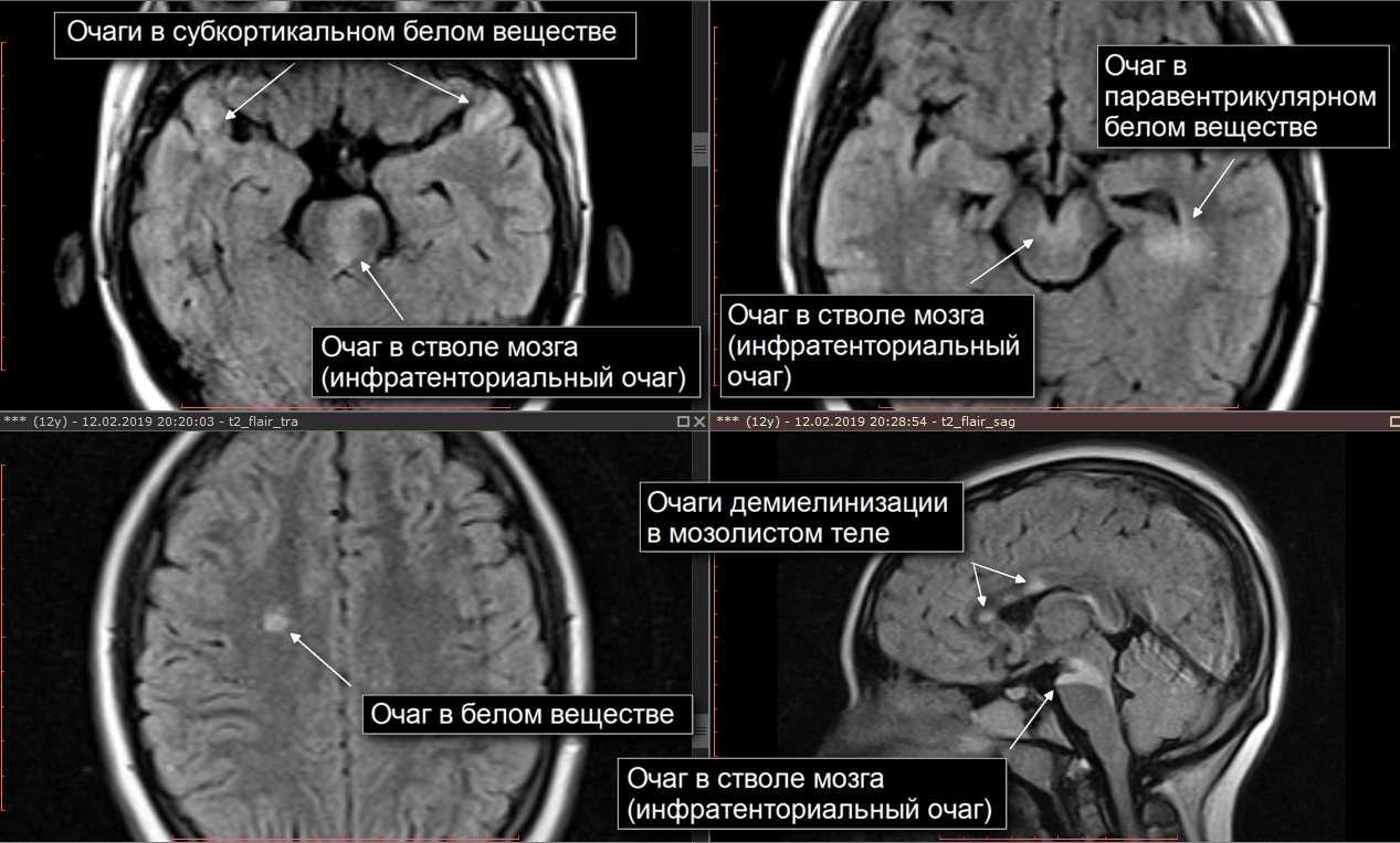 Дистрофические изменения в мозгу