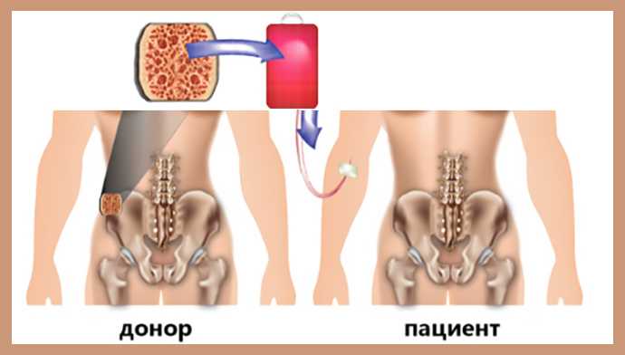 Нарушение костного мозга симптомы. Онкология костного мозга. Трансплантация костного мозга.