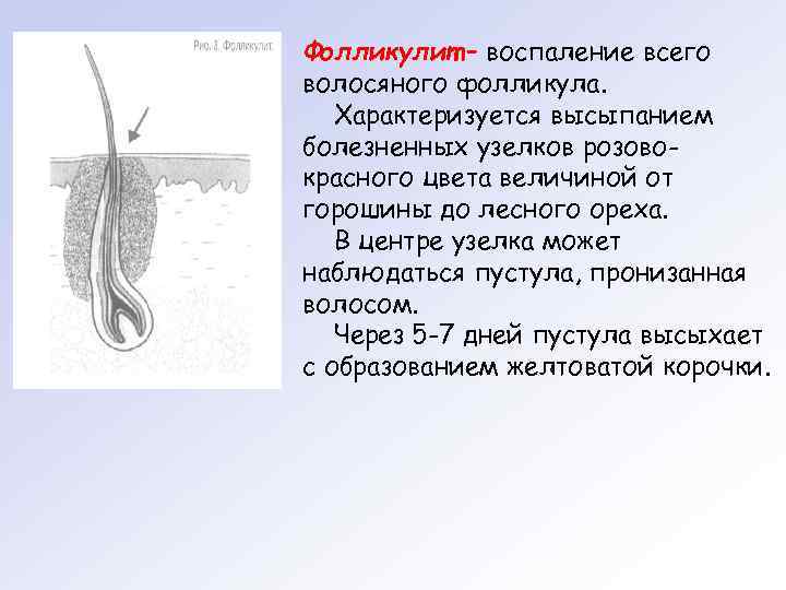 Что такое фолликулит и как от него избавиться?