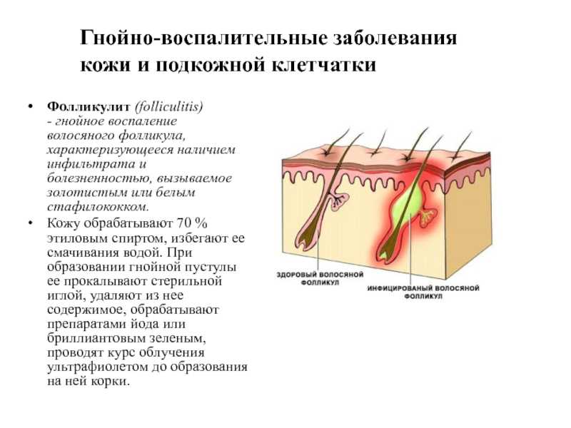 Фолликулит | симптомы | диагностика | лечение - docdoc.ru