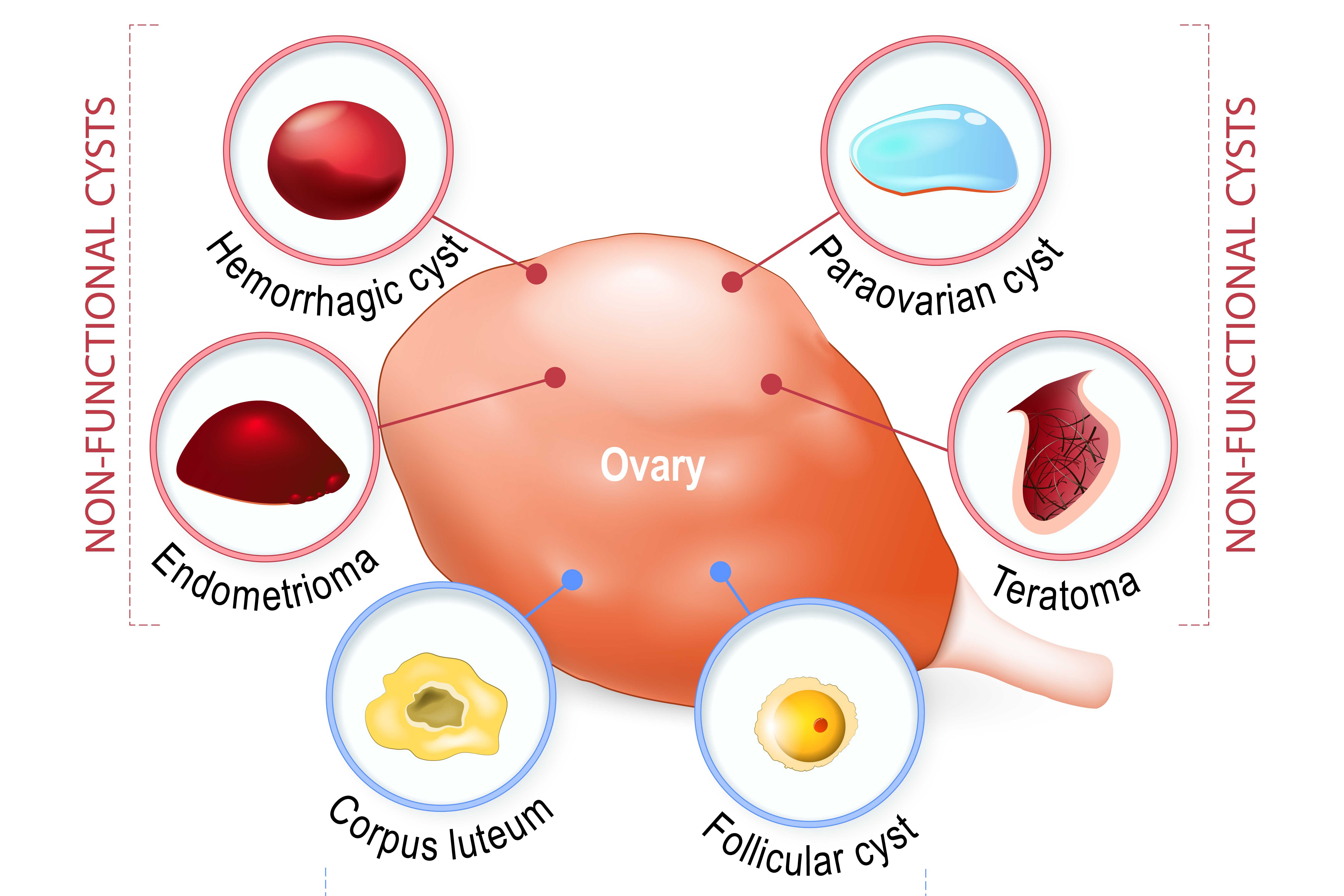 Лечение яичника у мужчин. Функциональные кисты яичника патогенез. Фолликулярная киста яичника классификация. Патогенез функциональных кист яичников.