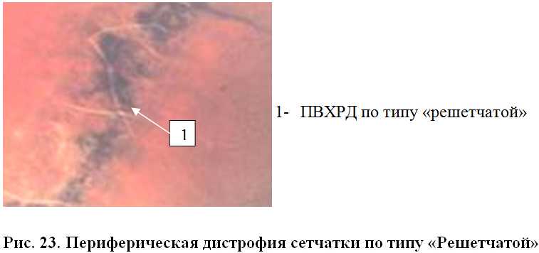 Возрастная макулярная дистрофия (дегенерация)