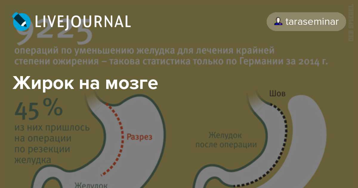Питание после бариатрической операции | фнкц фмба россии