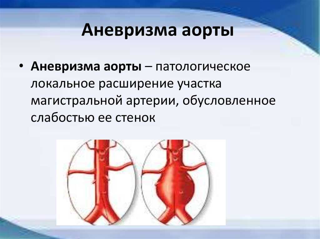 Симптомы и лечение аневризмы - medside.ru
