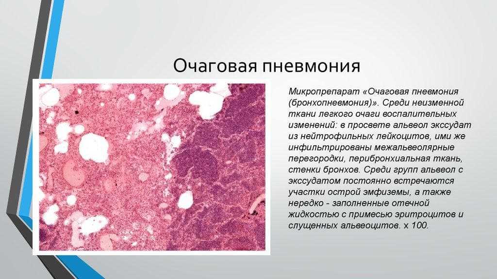 Пневмония | симптомы | диагностика | лечение - docdoc.ru