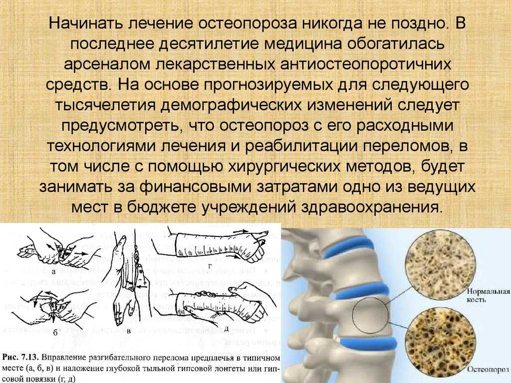 Обзор рекомендаций по лечению остеопороза | университетская клиника