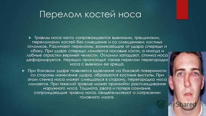 Перелом костей носа