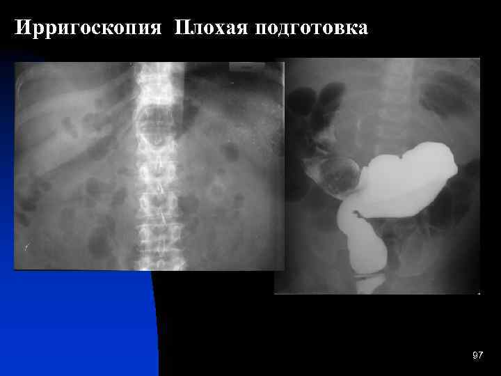 Ирригоскопия подготовка отзывы. Ирригоскопия Толстого кишечника. Ирригоскопия Толстого кишечника рентген. Ирригоскопия это рентгенологическое исследование. Ирригоскопия кишечника контрастное вещество.