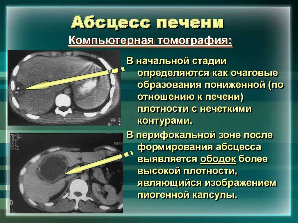 Абсцедирующая пневмония: причины, симптомы и лечение | медицинский центр «президент-мед»