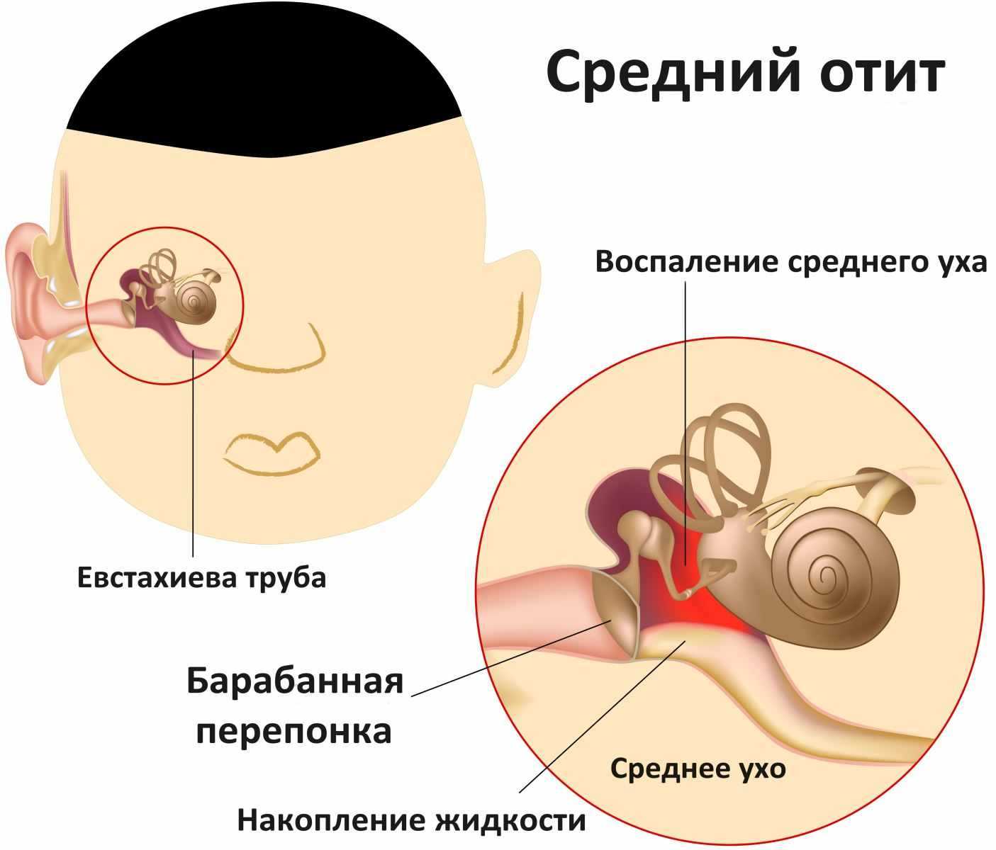 Средний отит картинка