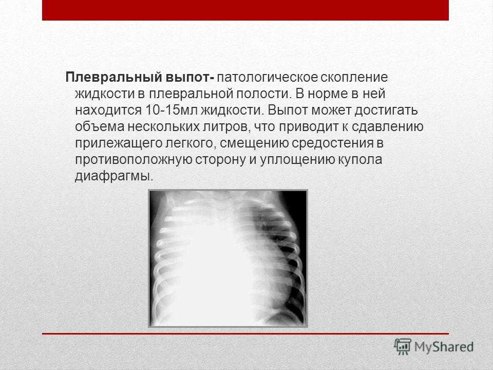 Двухсторонний плевральный выпот. Экссудат в плевральной полости. Норма жидкости в плевральной полости.