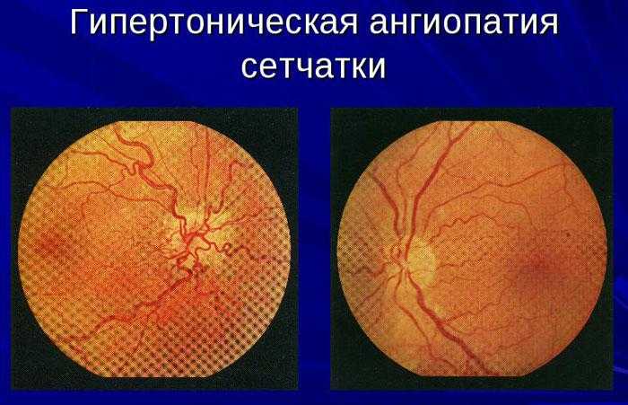 Сетчатки обоих глаз. Макроангиопатия сосудов сетчатки. Гипертоническая ангиопатия сетчатки. Гипертензивная ангиопатия глазное дно. Гипертензия ангиопатия сетчатки сосудов.