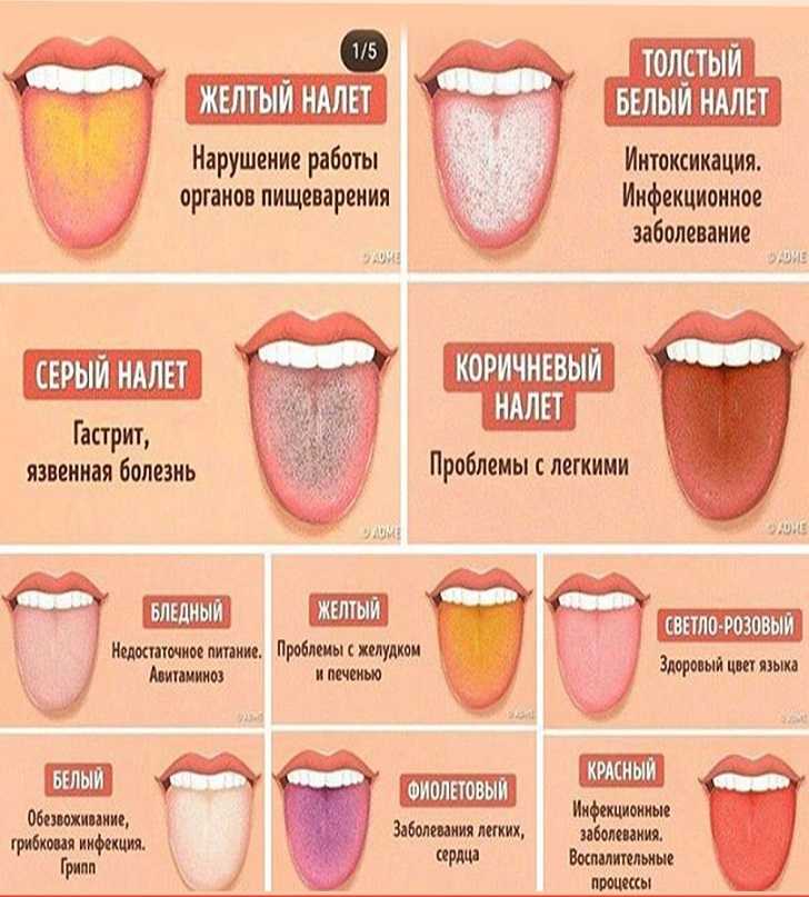 Диагноз по языку в картинках определение болезни