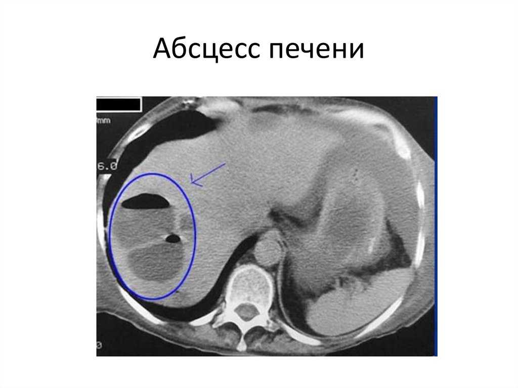 Абсцесс печени