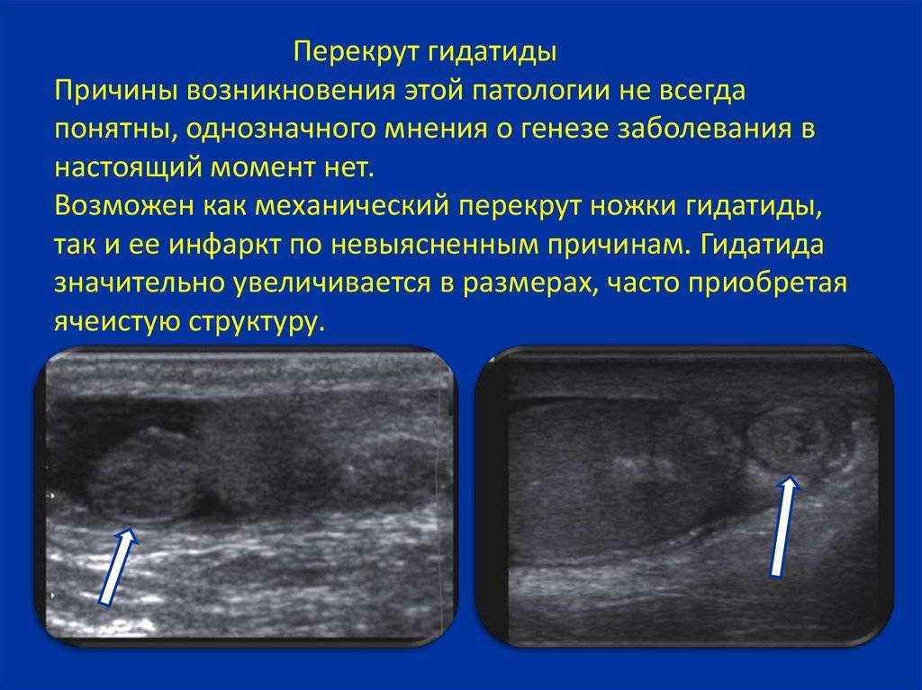 Перекрут семенного канатика | симптомы | диагностика | лечение - docdoc.ru