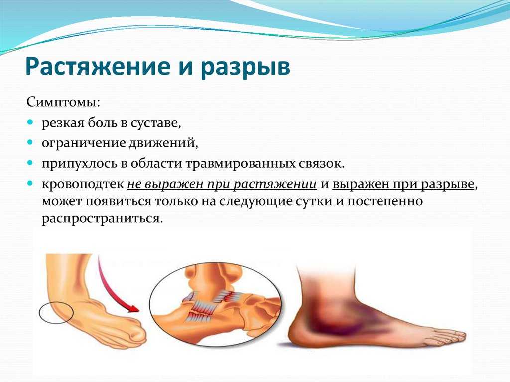 Растяжение связок!