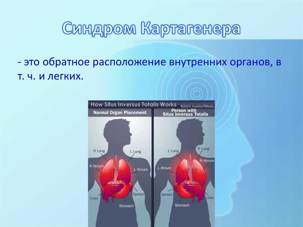 Синдром зиверта-картагенера у детей - medside.ru