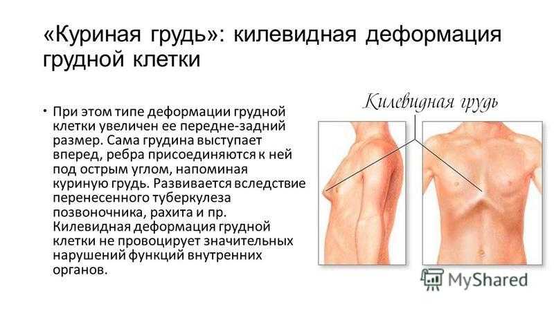 Грудная клетка лечение. Деформация грудной клетки. Килевидная грудная клетка. Воронкообразная и килевидная грудная клетка. Килевидная деформация грудины рентген.