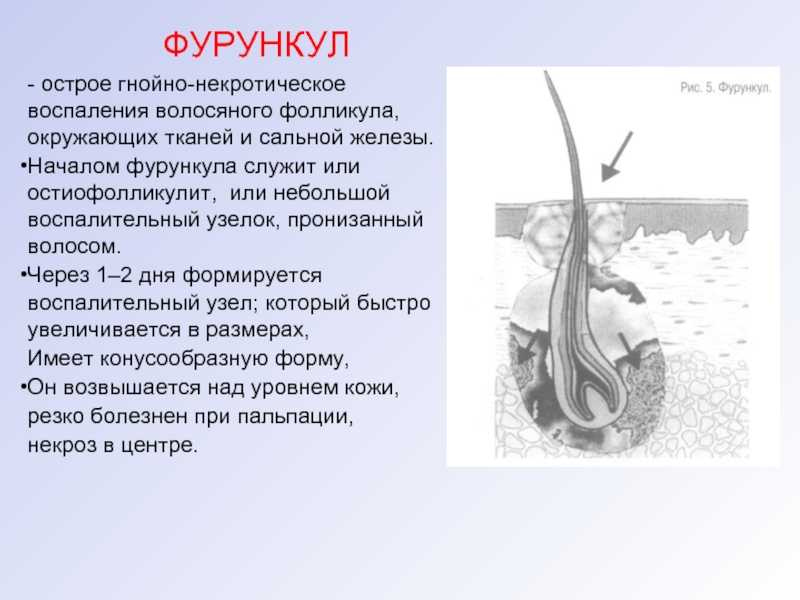 Фолликулит: причины, признаки симптомы с фото. лечение фолликулита волосистой части головы у лучших врачей - navimed. киев, украина