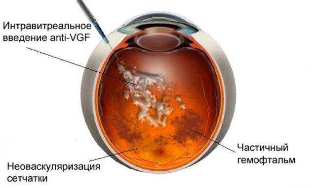Кровоизлияние в стекловидное. Интравитреальное Введение ингибиторов ангиогенеза. Гемофтальм стекловидного тела. Парциальный гемофтальм. Анти-VEGF интравитреальное Введение.