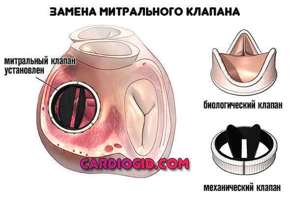 Митральный клапан после операции. Строение протеза митрального клапана. Сердце операция митральный клапан. Митральный клапан двустворчатый. Пластика створок митрального клапана.