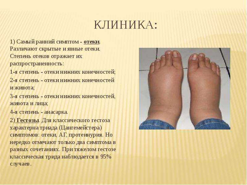 Причина отека ног — лимфедема