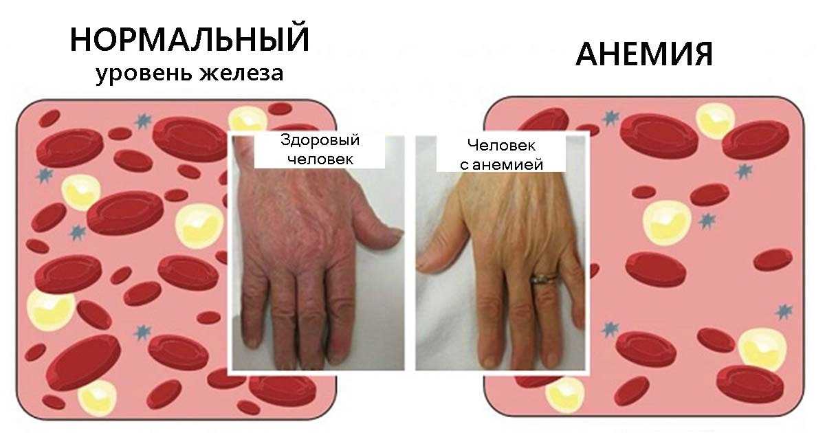 Клиническая картина железодефицитной анемии