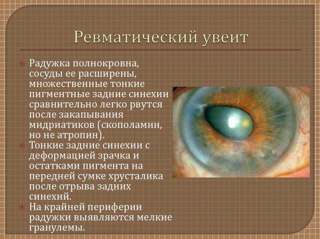 Дистрофии сетчатки глаза - причины, виды, симптомы и лечение