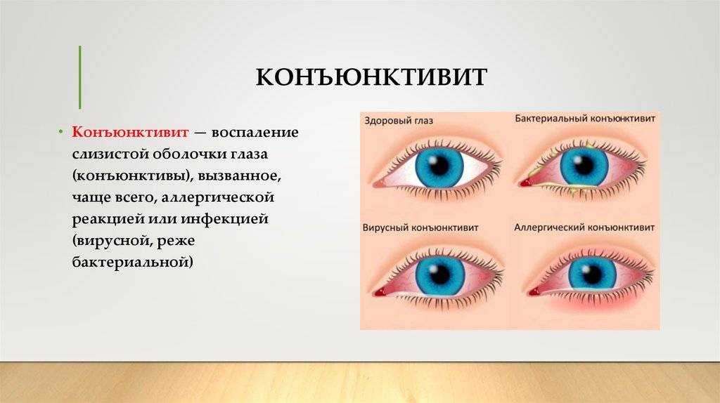 Чем отличается аллергическая форма конъюнктивита от остальных?