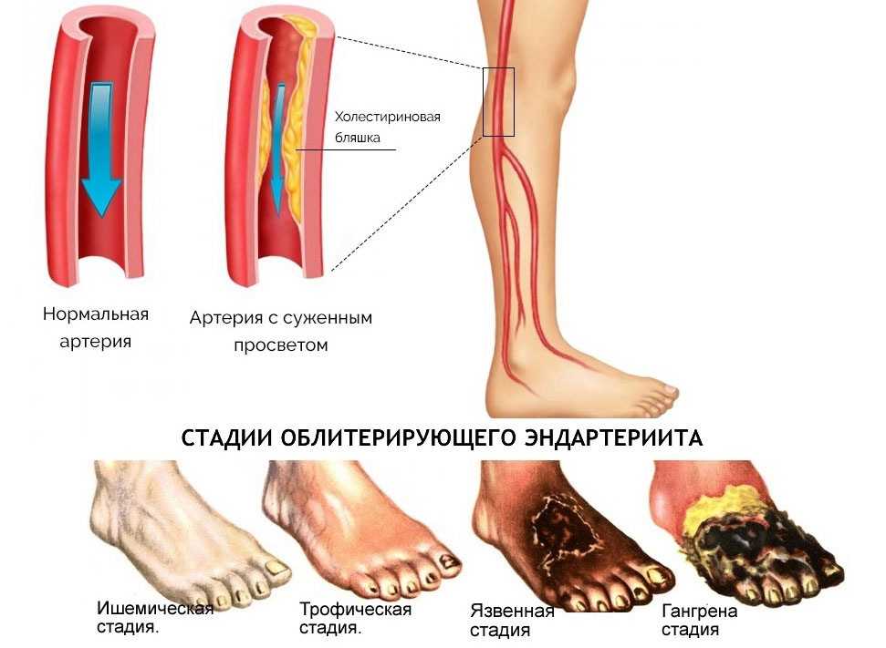 Облитерирующий атеросклероз картинки