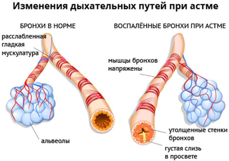 Питание при бронхиальной астме. «питание при бронхиальной астме» | мельников илья