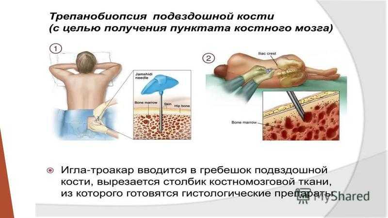 Полицитемия (эритремия, болезнь вакеза): причины и развитие, проявления, лечение, прогноз