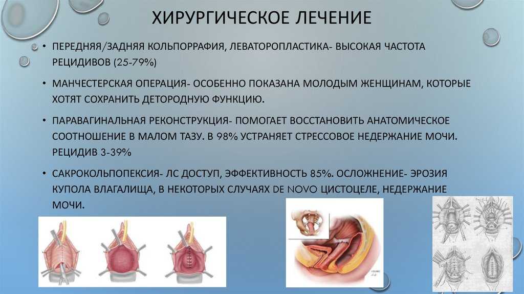 Лечение неполного выпадения матки, ректоцеле, цистоцеле, энтероцеле - клиника урологии мгмсу