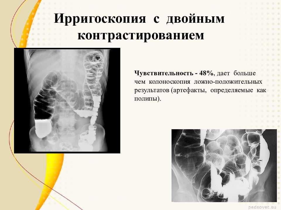 Диета перед колоноскопией - старые и новые рекомендации * клиника диана в санкт-петербурге
