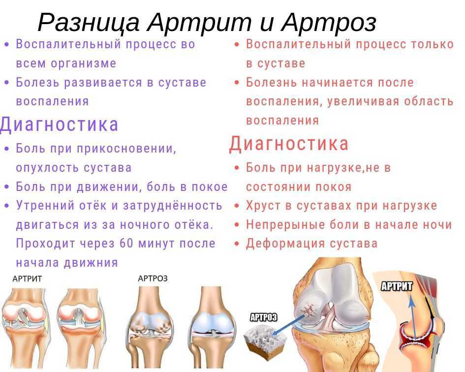 Артрит — что это такое, симптомы, причины, степени, первые признаки и лечение | 4-я городская клиническая больница имени н.е. савченко